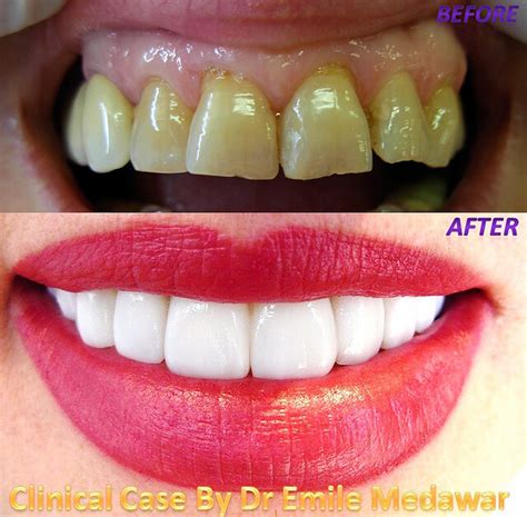 Veneers Before and After - Pictures, Popularity, Time, Color, Pros ...