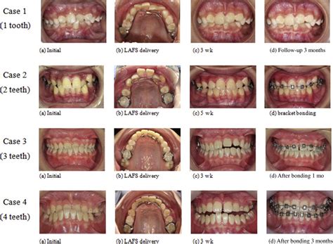 Anterior crossbite correction using a lingual arch with finger springs ...