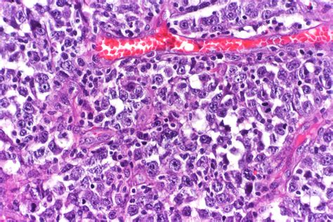 Diffuse Large B-Cell Lymphoma (DLBCL) | Leukemia and Lymphoma Society