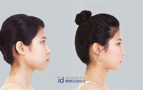 ID Hospital Korea: Mouth protrusion treatment, it is essential to ...