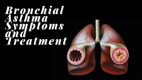 BRONCHIAL ASTHMA SYMPTOMS AND TREATMENT - YouTube