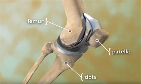 Total Knee Replacement Animation - OrthoInfo - AAOS