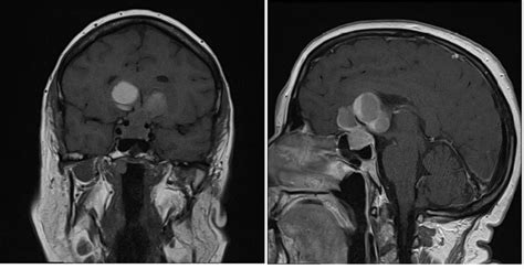 Atypical giant prolactinoma with frontal lobe manifestations | BMJ Case ...