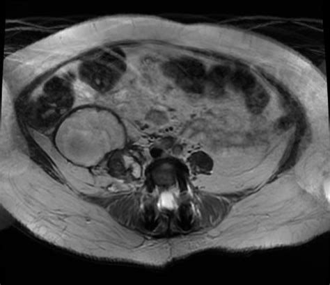 Retroperitoneal hematoma - wikidoc