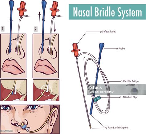 A Nasal Bridle Attaching A Nasogastric Tube To The Nasal Septum To ...