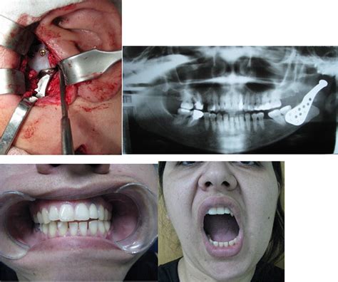 Reconstruction of TMJ with Prosthesis Joint | IntechOpen