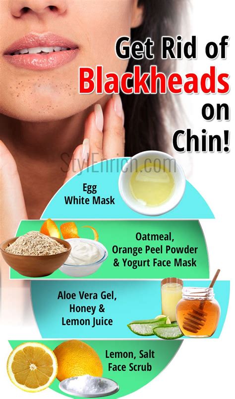 Blackheads On Chin : Home Remedies to Get Rid of Blackheads