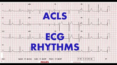 ACLS - ECG rhythm recognition & management, Part 1 - YouTube