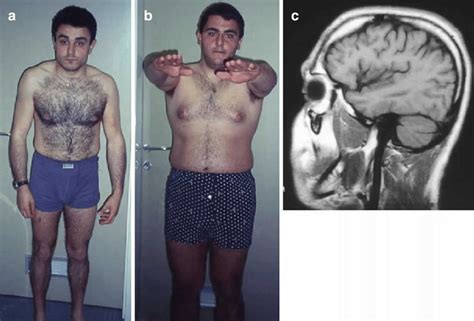 Paraplegia meaning, causes, symptoms, diagnosis, treatment & prognosis