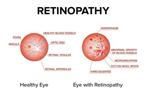 Valsalva Retinopathy: Causes, Symptoms and Treatment