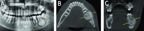 (A) Cementoblastoma. Panoramic radiograph of a periapical, sclerotic ...