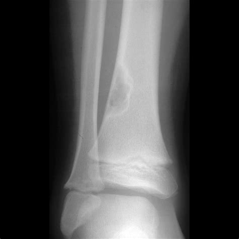 Fibrous Cortical Defect | Pediatric Radiology Reference Article ...