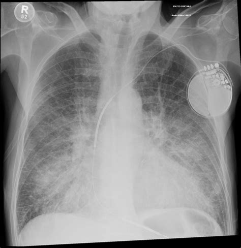 Pulmonary Edema Chest X Ray