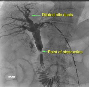 Blocked Bile Ducts - PTC | Sydney Medical Interventions