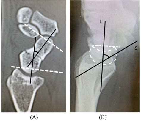 Method for the measurement of the intrascaphoid angle (ISA) (A) and ...