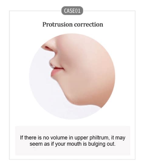 Protrusion correction | Answer Plastic Surgery