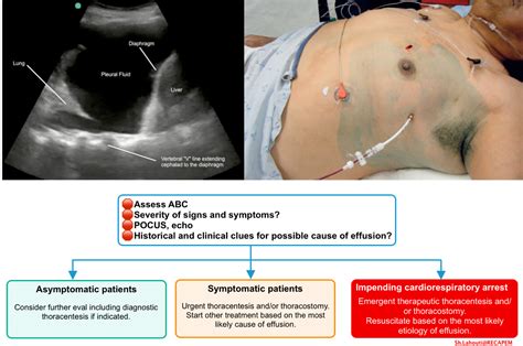 Ascites Vs Pleural Effusion Ultrasound