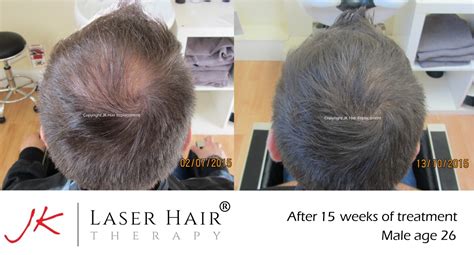 Laser Hair Therapy for Hair Regrowth for thinning Hair - JK Hair