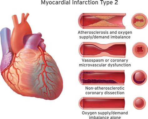 Diagram Pathophysiology Of Myocardial Infarction Ppt : Interleukin 1 ...