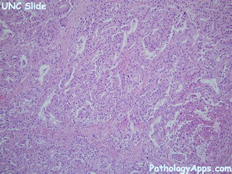 cholangiocarcinoma liver histology