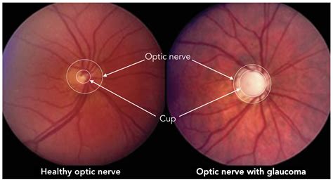 Improving Glaucoma Diagnosis Assembling Deep Networks and Voting Schemes