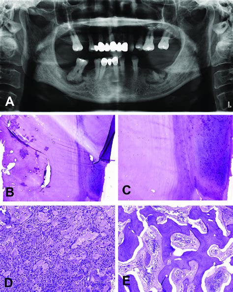 Panoramic radiograph and histological microphotographs of our case of ...