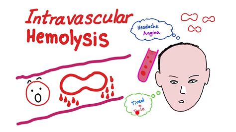 Intravascular Hemolysis - YouTube