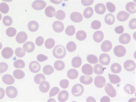 Beta Thalassemia Major Blood Smear