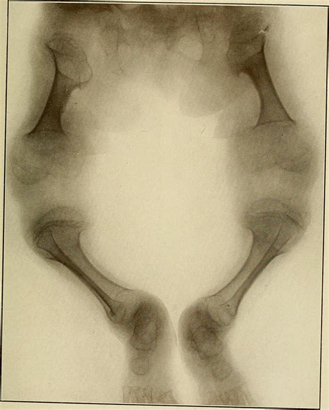 Causes, symptoms and treatments for achondroplasia | General center ...