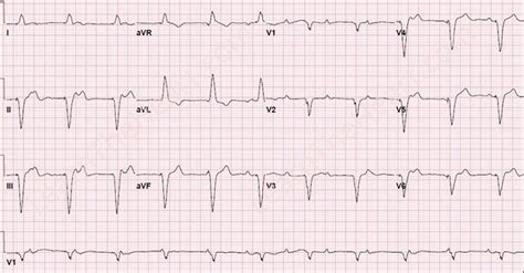 Third Degree AV Block with Ventricular Pacing ECG | Learn the Heart