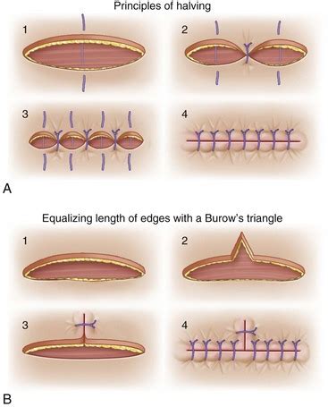 22: Secondary Revision of Soft Tissue Injury | Pocket Dentistry