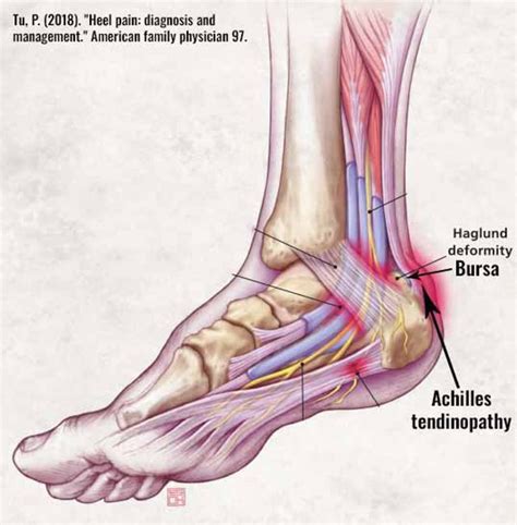 Achilles Bursitis Retrocalcaneal Bursitis Symptoms, Causes Treatment ...