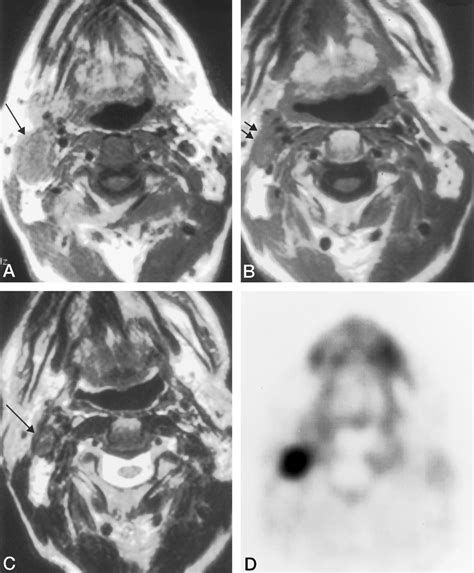 65-year-old man with a rightsided neck mass that yielded squamous cell ...