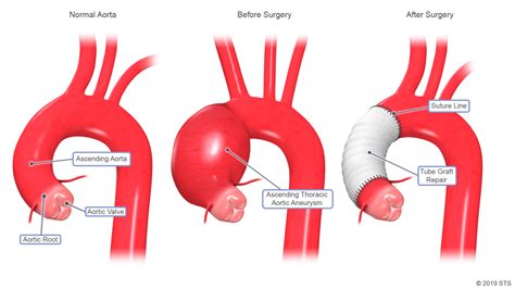 Aortic Aneurysms: Defusing the Ticking Time Bomb - Gregory Koshkarian ...