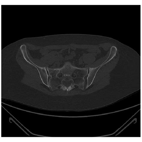 MRI T2 axial scan showed bone marrow edema at the sacrum. | Download ...