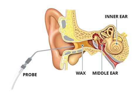 Ear Wax Removal | Sharmans Pharmacy