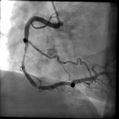 Coronary Angiography - Concord Cardiology