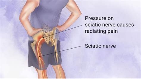 Chiropractic Care for Sciatica Pain Treatment - Wilbeck Chiropractic