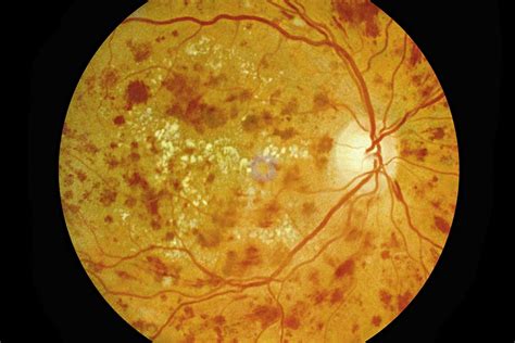 Understand the Four Stages of Diabetic Retinopathy