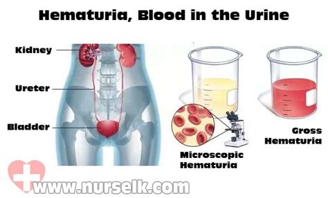 Hematuria, Blood in the Urine | Nurselk.com