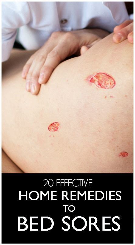 8 Best home remedies for bed sores or pressure sores images in 2020 ...