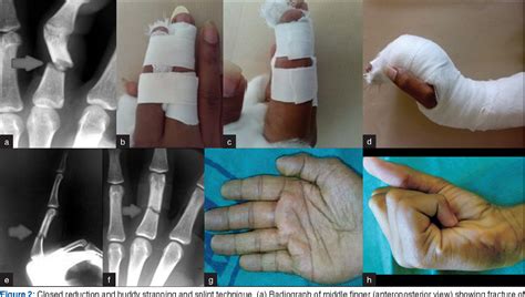 Proximal Phalanx Fracture Splint