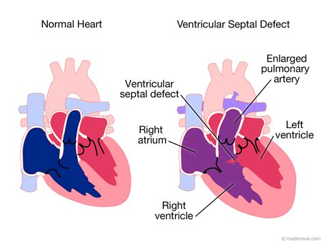 Total Anomalous Pulmonary Venous Circulation (TAPVC)