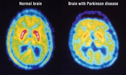 Patient Basics: Positron Emission Tomography (PET Scan) | 2 Minute Medicine