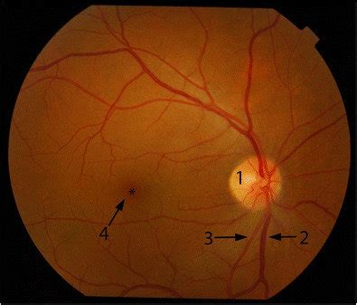 Normal fundoscopy of the right eye shows the oval optic disc (1 ...