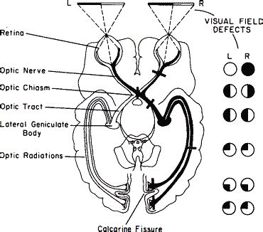 Cortical Blindness: Loss of Vision Without Any Ophthalmological Cause ...