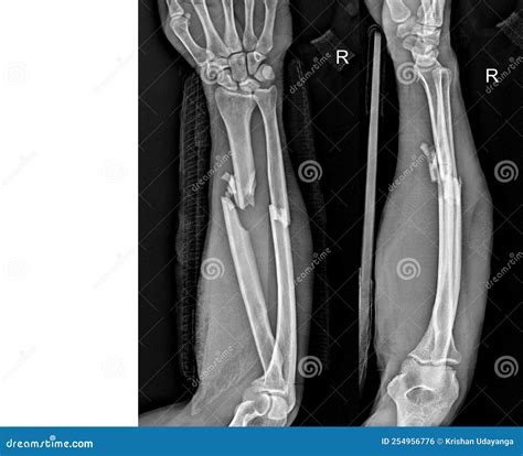 Ulna Fracture X Ray