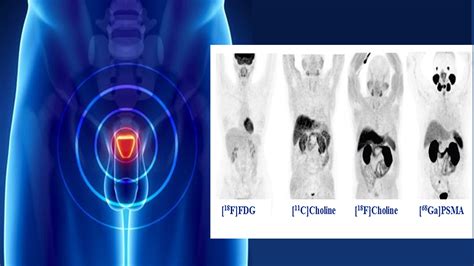 NEW CRP: Use of PET–CT with Gallium-68 Labelled Prostate Specific ...