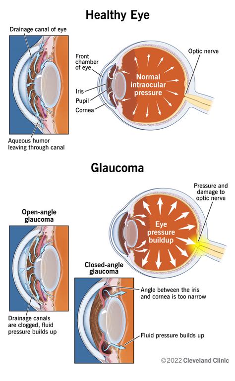 Glaucoma: What It Is, Symptoms, Causes, Types & Treatment