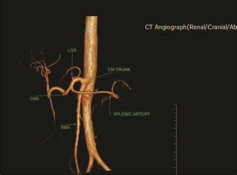 Assessment of Celiac Axis and Hepatic Artery Variations in ...